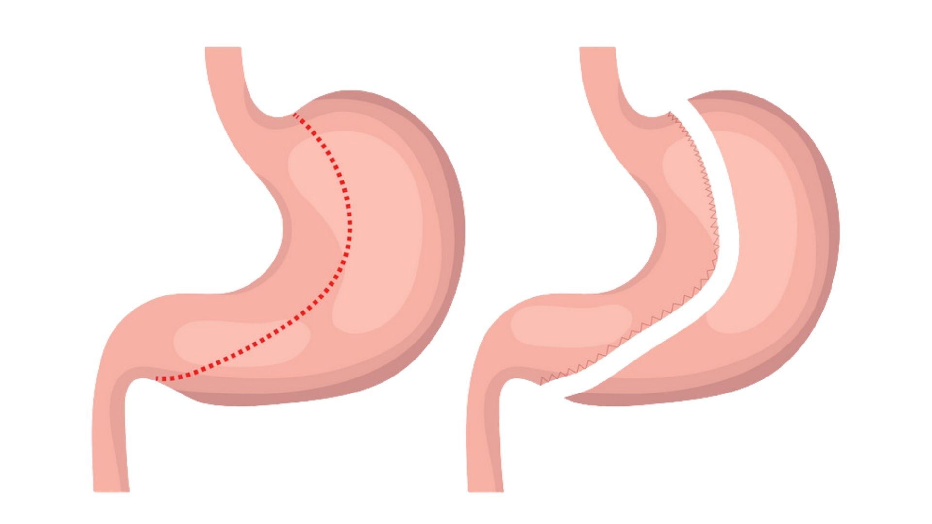 Gastric Sleeve and Improved Metabolism